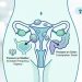 Why Fibroids Cause Constipation and Bladder Problems — and How to Get Relief